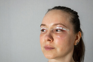 Naklejka premium woman face after plastic surgery, blepharoplasty operation, swelling eye bags, incisions with removable stitches, swollen skin and bruised eyelids. Cosmetic surgery to remove excess skin or fat 