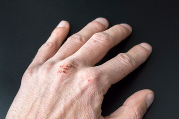 Chapped hands from cold weather, dry cracked knuckles