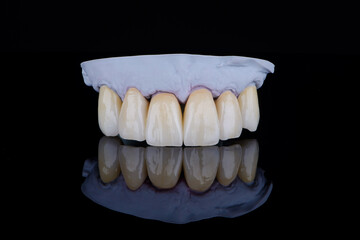 High-quality naturally dental single crowns made of zirconium for fixation to the frontal teeth of upper jaw. © gorynvd