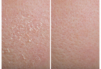 Collage demonstrating comparison of dry and moisturized human skin, closeup