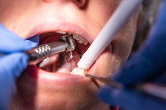 Lady having dental filling at dentist office