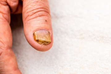 Nail fungus infection on the thumb finger.Fungal infection on nail hand,finger with...