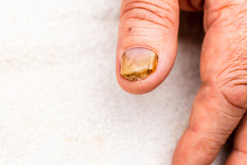 Fungal infection on nail hand,finger with onychomycosis,damage on human hand.Nail fungus infection...