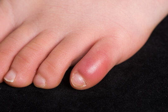 close up of Child's toe showing symptom of chilblain known as pernio