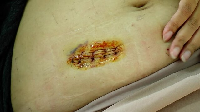 wash the wound,A woman shows an appendicitis scar on his stomach, a scar from an appendicitis operation on his stomach. appendectomy.wash the wound.Medicine concept