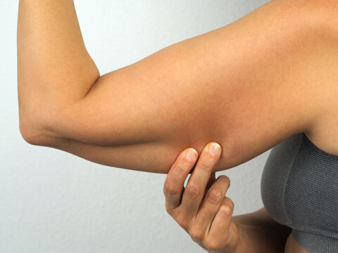 Woman grabbing skin on her upper arm with excess fat.