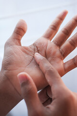 close up of Dry cracked skin of a men's hand 