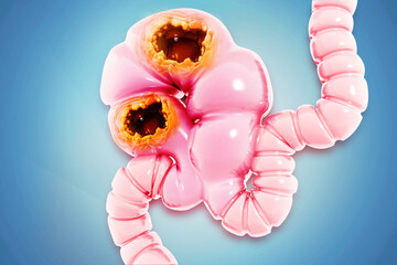 Colorectal (Colon) Cancer, conditions, causes and treatment. 3d illustration