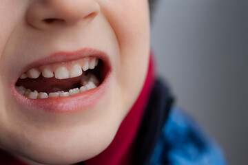 A new tooth is growing, but the old one has not yet fallen out. Close-up of the mouth.