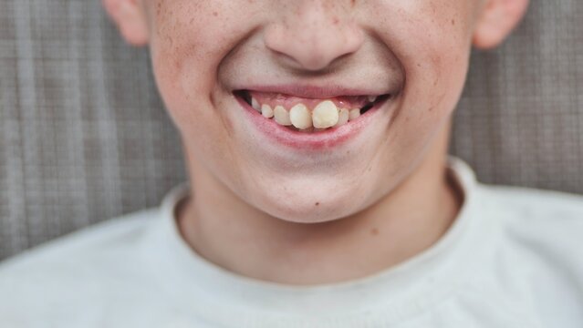 The boy's front crooked teeth.