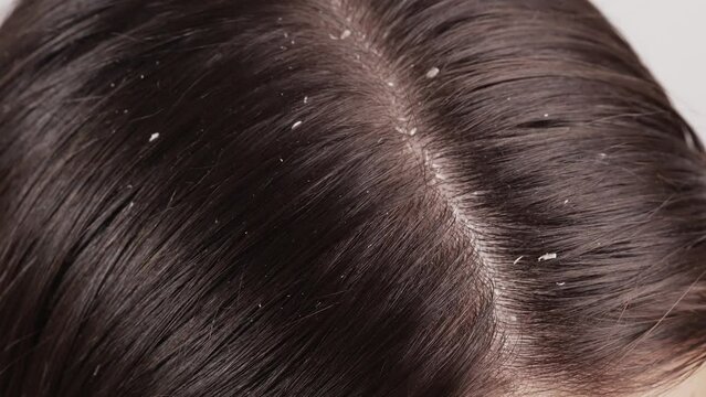 Hair of a woman with dandruff