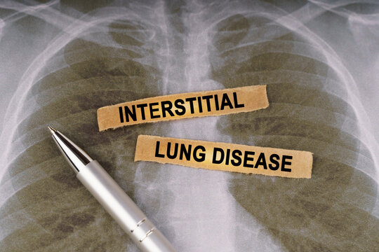 On a human chest x-ray, a pen and strips of paper labeled - INTERSTITIAL LUNG DISEASE