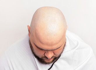 before and after bald head of a man. bald head of a man, shaving bald in barber shop.