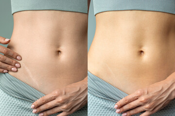 An advertisement for a cream, ointment or gel for removing scars after surgery and cuts. Supports...