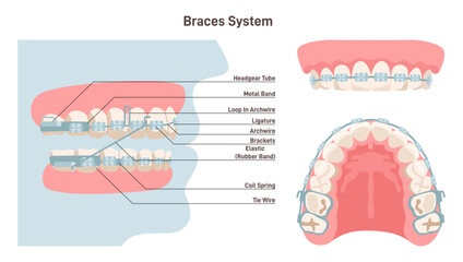 Dental braces system. Installed brackets system side, front and bottom