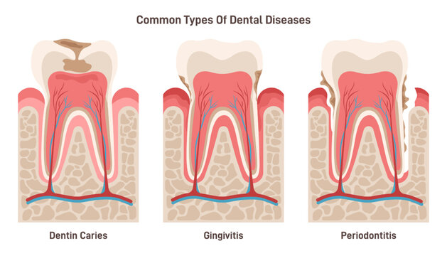 Dental disease set. Dentin caries, gingivitis and periodontitis. Oral cavity