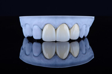 Fototapeta na wymiar High-quality naturally dental single crowns made of zirconium for fixation to the frontal teeth of upper jaw.