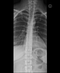 Thoracic spine x-ray. AP view. A significant kyphosis with mild right convex scoliosis around the thoracolumbar transition. Normal vertebral body configuration. Intervertebral spaces are unaffected.