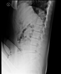Lumbosacral spine x-ray. Lateral view. Lumbar lordosis with mild right convex scoliosis around the...