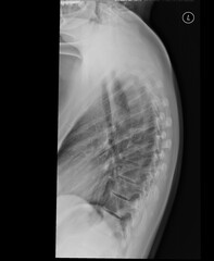 Thoracic spine x-ray. Lateral view. A kyphosis with mild right convex scoliosis around the thoracolumbar transition. Normal vertebral body configuration. Intervertebral spaces are unaffected.