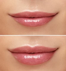 Fotobehang Women lips correction before and after comparison. Hyaluronic acid injection. Beauty lip treatment procedure. © Beauty Agent Studio