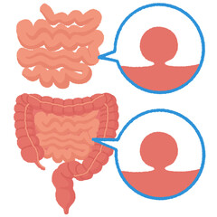 小腸腫瘍のイラスト