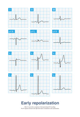 The ECG characteristic change of early repolarization is J point and ST segment elevation, which is easy to be misdiagnosed as acute myocardial infarction, especially when the patient has symptoms.