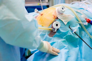 Selective focus on trocar tubes in patient's body during surgery. Minimally invasive surgery.