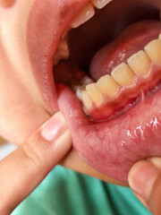 Kid's gum inflammation. red bleeding gums with bum. Close up. Dentistry, dental care.