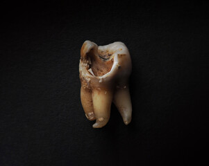 Tooth decay on black background. Macro shot of a decayed teeth till root after extraction of...