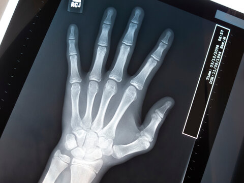 X-ray of a hand and wrist on a scanning bed; Pennsylvania, United States of America