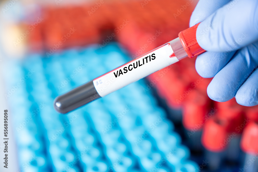 Sticker vasculitis. vasculitis disease blood test in doctor hand