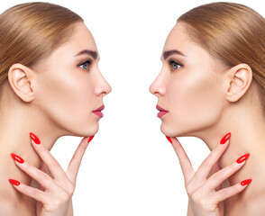 Woman before and after cheekbones shape correction.