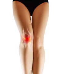 Female legs with red area on knee. Kneecap trauma concept.