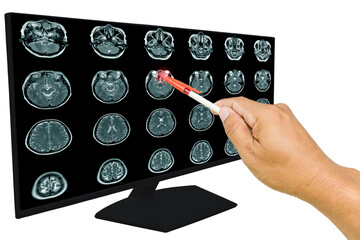 The doctor reported the Magnetic resonance imaging (MRI) of the tumor, sagittal view.A 56 years old man , with and without contrast media, .Healthcare and education concept.