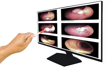 Close up Doctor point out the computer screen, report of gastrointestinal endoscopy, medical imaging EGD looking for structures in the esophagus.Medical education concept.