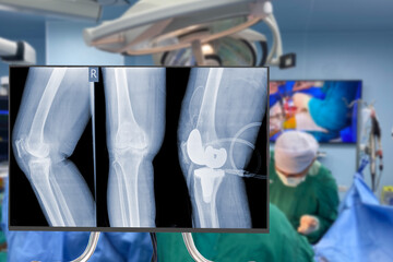 x-ray of  knee. Blurry Traumatology orthopedic surgery hospital operating room for the Total Knee...