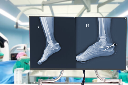 X-ray heel bone fracture(Calcaneus fracture) which is treated by surgery Blurry Traumatology orthopedic surgery hospital operating room for the bone operation. Medical health and Education concept.