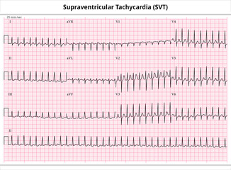 ECG Supraventricular Tachycardia - 12 Leads ECG Paper