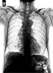 Film chest x-ray show alveolar infiltrate at left middle lung