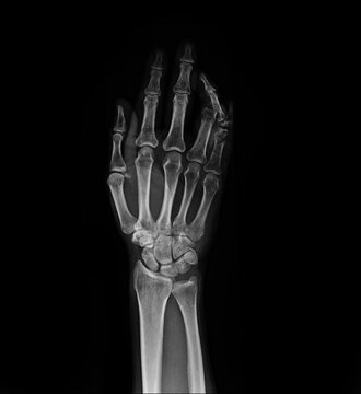 Film x-ray fracture ring finger and Fracture little finger . Film x-ray AP