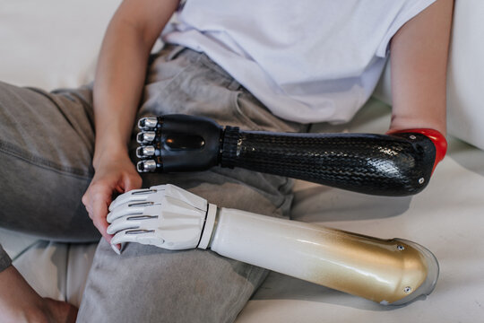 Cropped Image Of Young Woman In Casual Sitting On Sofa Compares Her Bionic Hand Prosthesis With Another Carbon Artificial Arm At Home. Rehabilitation After Trauma. Hi Tech Medicine.