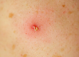 Acne, pus pimples, suppurating pimple, burst pimple with leaking pus closeup with shallow depth of...