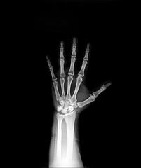 x ray hand AP view normal