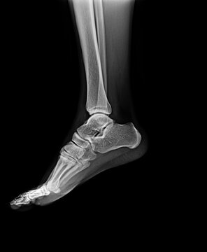 X-ray normal human foot . Lateral view 