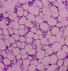 Lymph node (biopsy): Hodgkin's lymphoma, mixed cellularity, monotonous population of lymphocytes, histiocytes, plasma cell, large mononuclear cells. Hodgkin's disease.