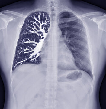  Fusion image of Chest x-ray and CT Chest  Coronal view  for lung infection from covid-19 Concept.
