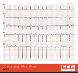 Sometimes, coarse atrial fibrillation is easily misdiagnosed as atrial flutter, but their shape, amplitude and frequency are almost beat by beat changes.