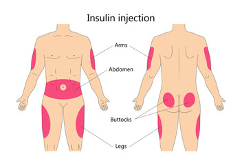 Insulin injection infographic vector. Diabetes treatment and insulin shots area on human body. Buttocks, upper outer arms and abdomen places. © passionart