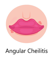 Herpes lips vector. Simplex virus infection causes recurring episodes of small, painful, fluid-filled blisters on skin, mouth, lips.